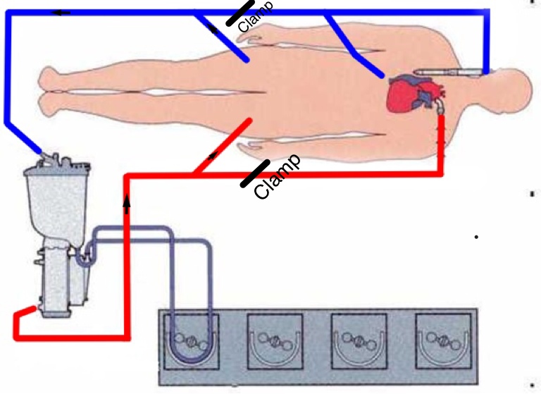 Pulmonary Valve Replacement in Adult Congenital Cardiac Surgery